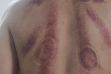 가정용 웰니스를 위한 전동 괄사 기기: 온열 요법, 흡입, 경락 소통, 부항 기능을 갖춘 스마트 마사지기 photo review